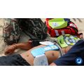 Cardiac arrest victim with Zoll AED pads on.